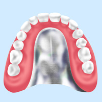 金属床の入れ歯